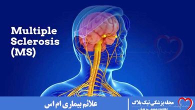 بیماری ام اس
