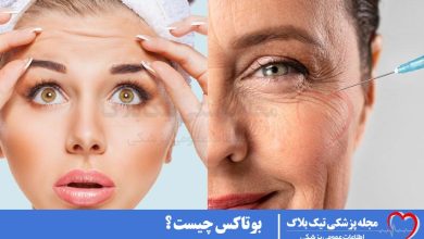 بوتاکس چیست ؟